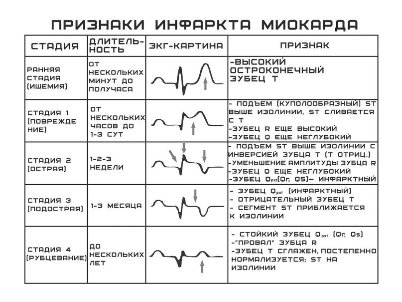 Нарастание зубца. ЭКГ отрицательный зубец т в v1-v3. Отрицательный зубец т в 3 отведении на ЭКГ. ЭКГ высокий зубец т v2-v4. Зубец т в 3 отведении норма ЭКГ.