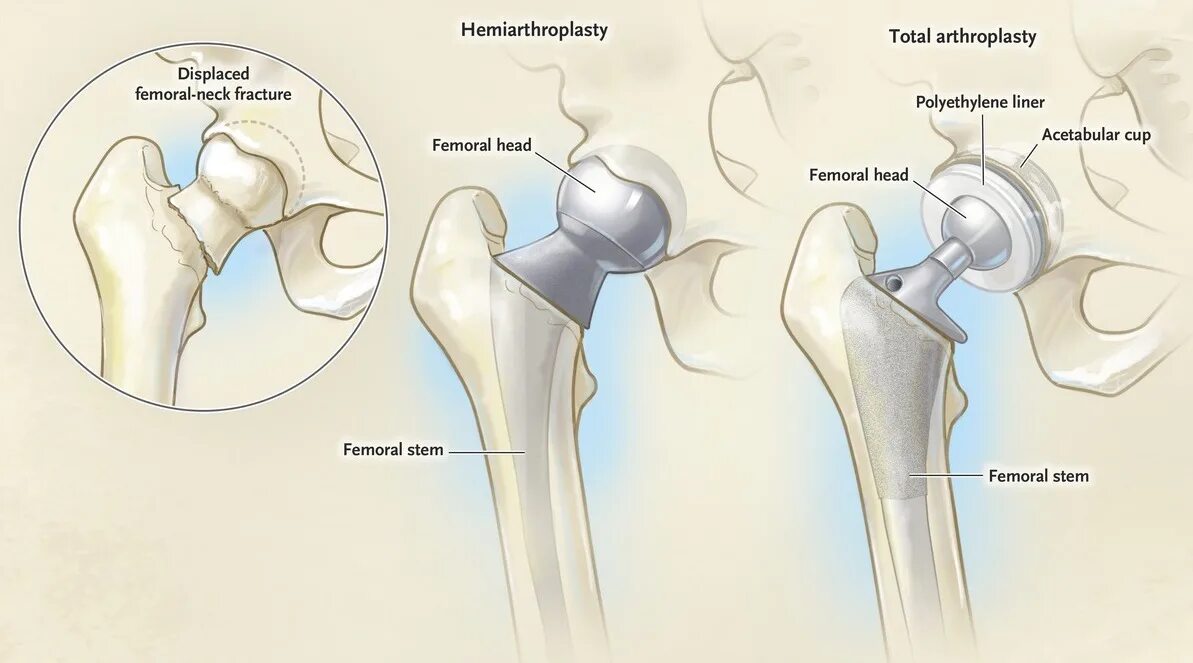 Как происходит операция по замене тазобедренного сустава. Эндопротезирование тотальными протезами тазобедренного сустава. Протез тазобедренный сустав тазобедренного сустава. Сустав ТБС эндопротез. Эндопротез шейки бедра.