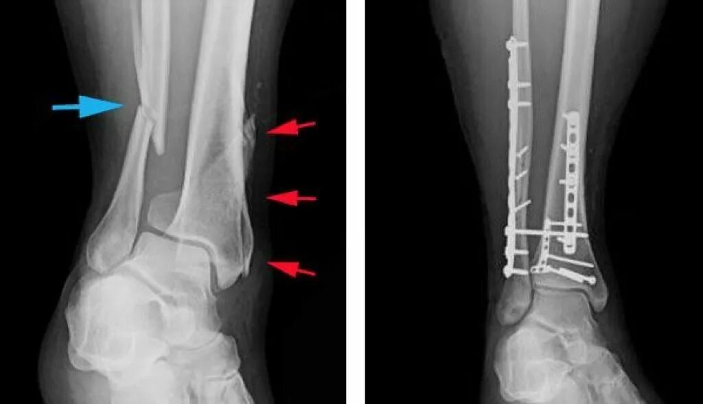 малоберцовая кость перелом. остеосинтез двухлодыжечный перелом. малоберцовая кость со смещением. перелом малой берцовой кости. перелом голени и малоберцовой кости.