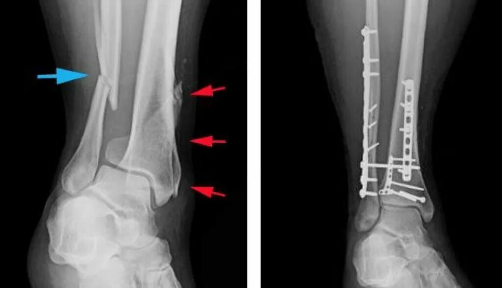 Укладка голеностопного сустава. Перелом малоберцовой кости рентген. Перелом голени и малоберцовой кости. Перелом н3 малой берцовой кости. Перелом малоберцовой кости у колена.
