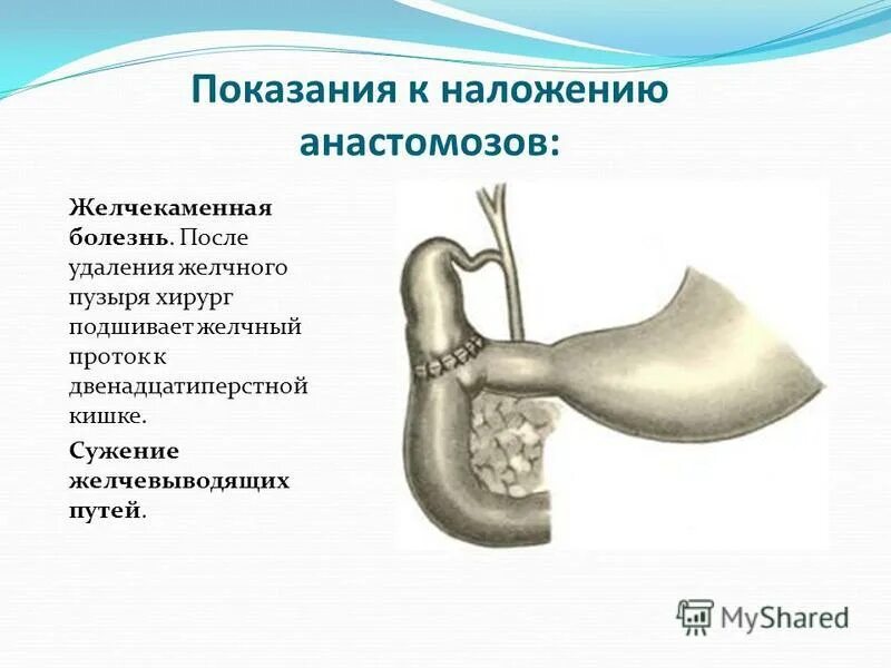 Как жить без желчного пузыря. Резекция желчного пузыря. Анастомозы желчного пузыря. Показания к наложению анастомоза. Разрез при удалении желчного пузыря.