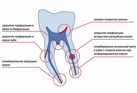 Перфорация пульпы
