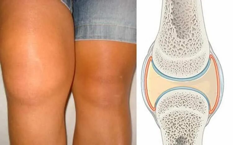 Препателлярный бурсит. Синовит коленного сустава. Что такое синовит коленного коленного сустава.