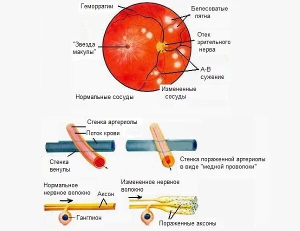 Ангиопатия сосудов мкб. Ангиопатия сосудов сетчатки мкб. Гипертоническая ангиопатия сетчатки мкб. Ангиосклероз сетчатки глаза что это такое. Гипертоническая ангиопатия сетчатки мкб 10.