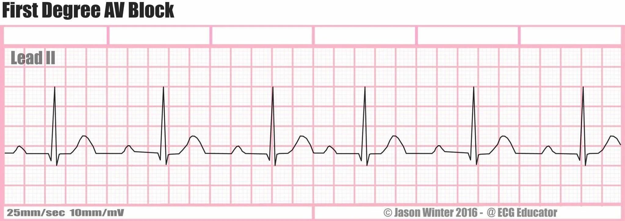 Ventriculiar taxicardia EKG. Ventricular tachycardia ECG. Atrial tachycardia ECG. Ритм коронарного синуса на ЭКГ. Sites type 1