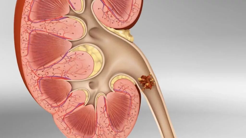 Камни в почках заболевание. Нефролитиаз нефролитиаз. Мочекаменная болезнь (нефролитиаз). Нефролитиаз почек что это такое симптомы. Коралловидный нефролитиаз.