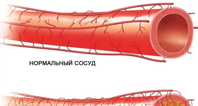 Ранение кровеносных сосудов рисунок. Тромборезистентность эндотелия сосудистой стенки. Атеросклероз артерий флэт. Расширение сосудов кожи. Расширение сосудов в организме