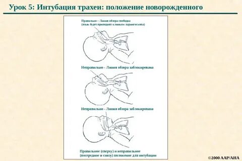Интубация трахеи дети
