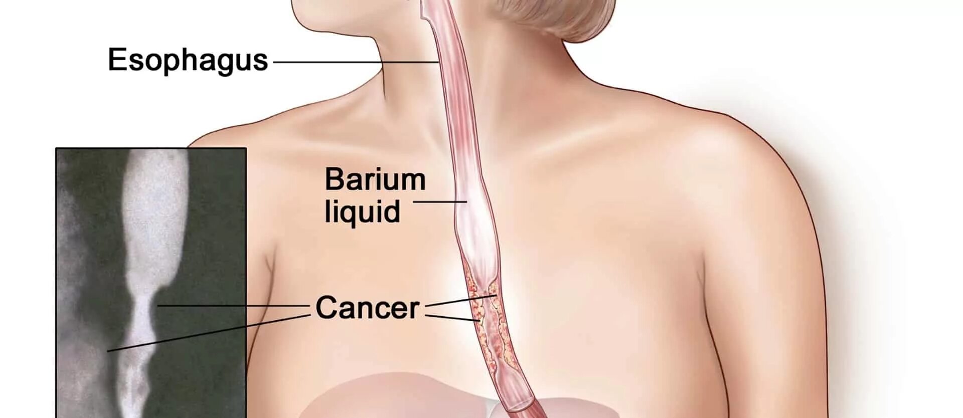 Пищевод б. Пищевод. Кансер пищевода.