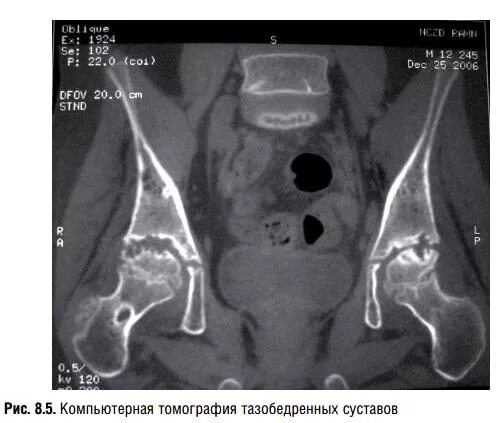 Артрит кт. Артрит тазобедренного сустава кт. Гнойный артрит тазобедренного сустава кт. Ревматоидный артрит тазобедренного сустава кт.