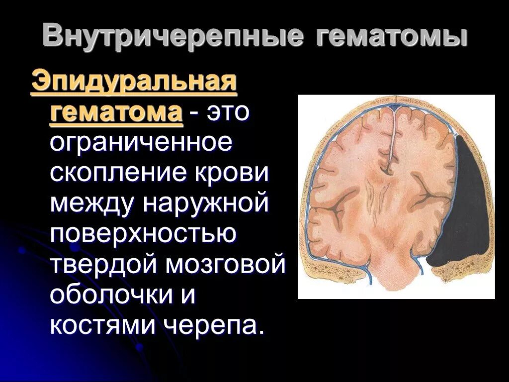 Субдуральная и эпидуральная гематома. Внутричерепная гематома. Гематома в головном мозге. Хроническая эпидуральная гематома.