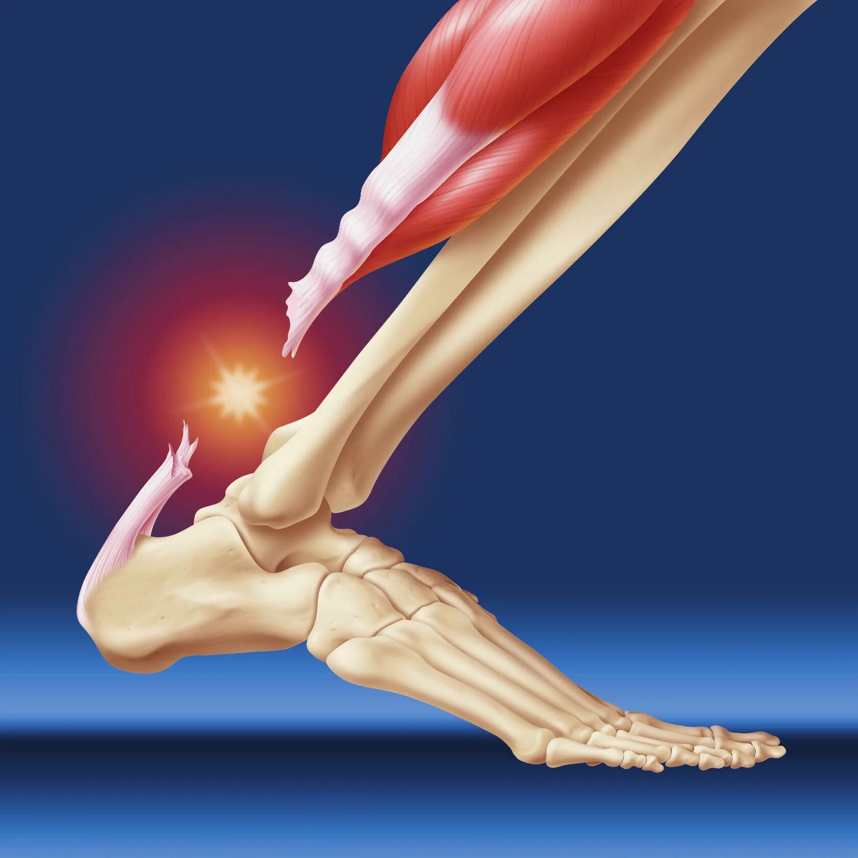 Ахиллово сухожилие разрыв ахиллова сухожилия. Крепитирующий тендовагинит Ахилла. Повреждения ахиллесового сухожилия. Растяжение ахиллова сухожилия. Achilles tendon tendinitis.