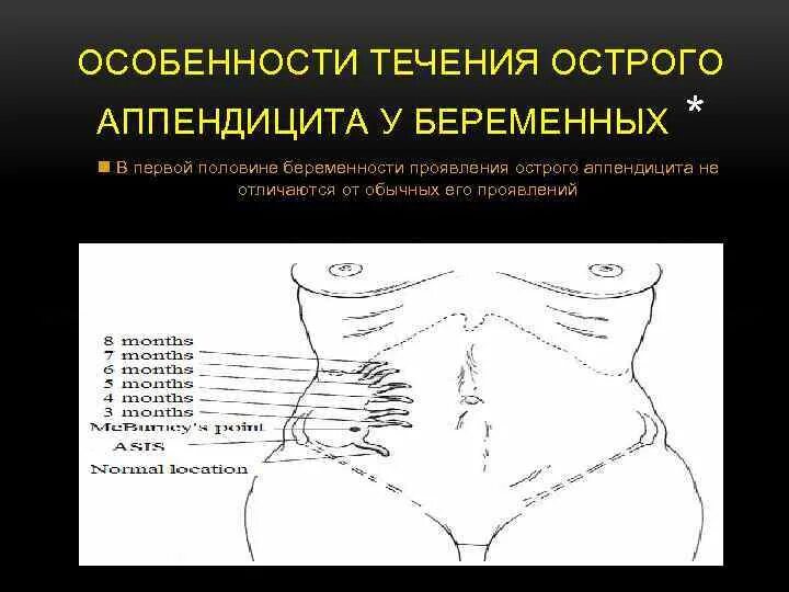 Где располагается беременность. Где располагается беременность