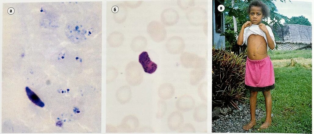 Дерево малярия. Малярийный плазмодий симптомы. Малярийный плазмодий больные. Тропическая малярия пароксизмы.
