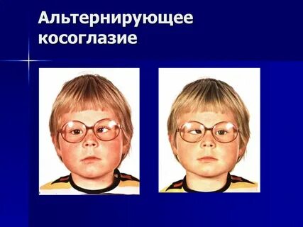 Альтернирующее косоглазие