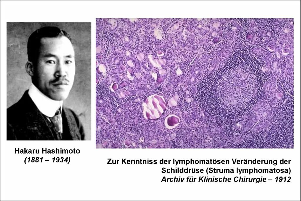 Хашимото болезнь у женщин. Аутоиммунный тиреоидит зоб Хашимото микропрепарат. Аутоиммунный тиреоидит Хашимото патологическая анатомия. Болезнь Хасимото щитовидной железы..