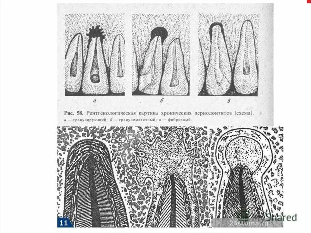 Фиброзный периодонтит. Периодонтит фиброзный гранулематозный гранулирующий. Хронический гранулематозный периодонтит. Хронический гранулирующий и гранулематозный периодонтит разница. Гранулирующий периодонтит схема.