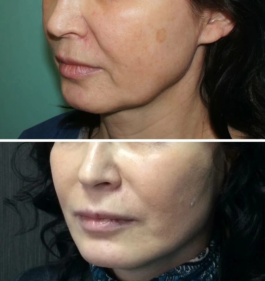 брыли на лице форум. мезонити для подтяжки лица. мезонити для подтяжки подбородка. брыли на лице. брыли на лице пластика до после.