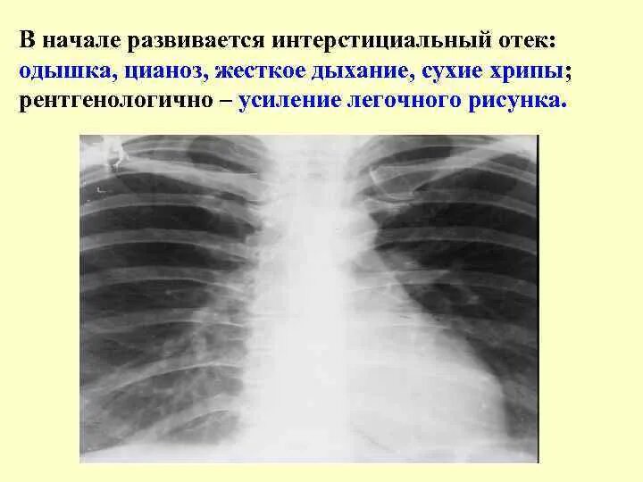 Усиленная легочного рисунка. Лёгочный рисунок усилен интерстициальным компонентом. Интерстициальный легочный рисунок. Легочный рисунок усилен.