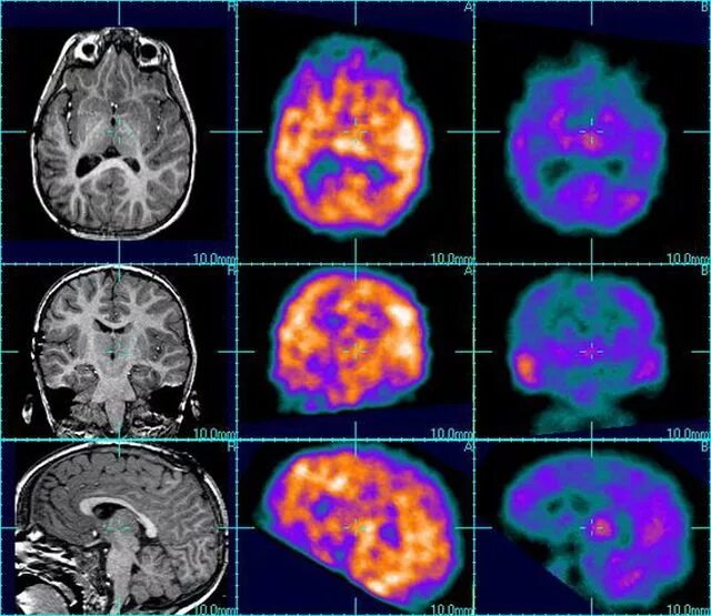 Мрт паническая атака. ПЭТ-кт головного мозга при эпилепсии. ПЭТ кт эпилепсия. Мрт головного мозга эпилепсия. ПЭТ кт при эпилепсии.