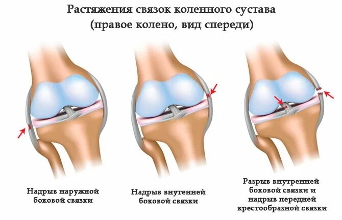 Симптомы повреждения коленных связок. Задняя крестообразная связка коленного сустава анатомия. Классификация разрыва связок коленного сустава.