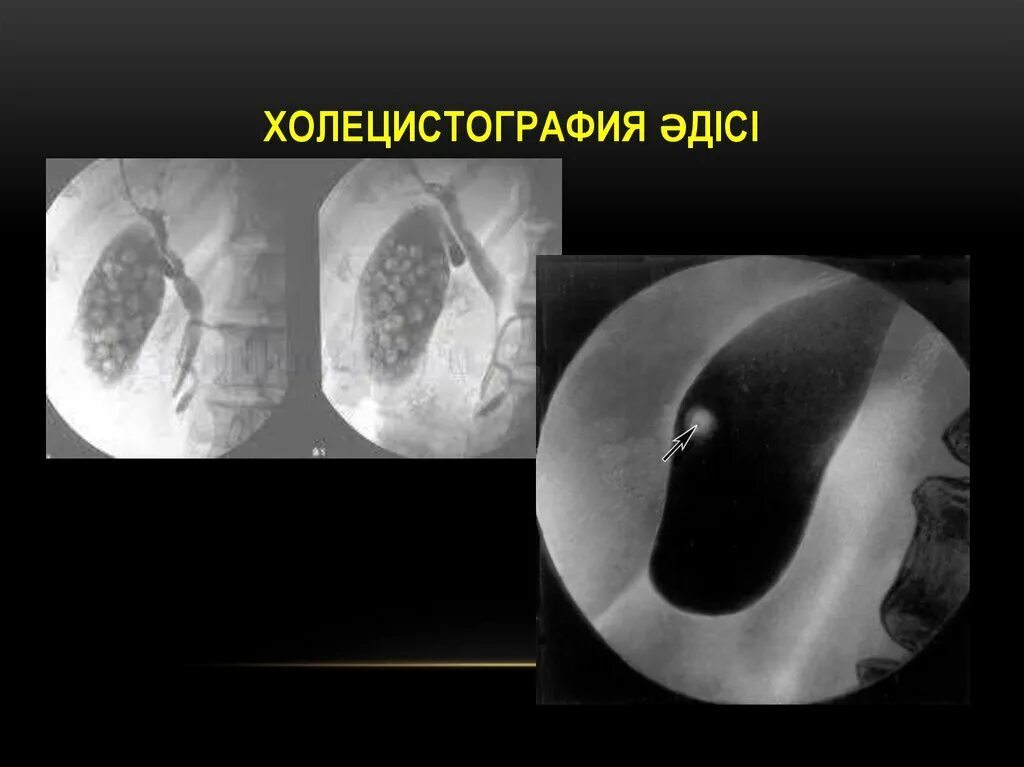 Холецистография желчнокаменная болезнь. Хронический холецистит холецистография. Холецистография противопоказана больным. Рентгенологические исследования (холецистография, холангиография):. Холецистография метод исследования.