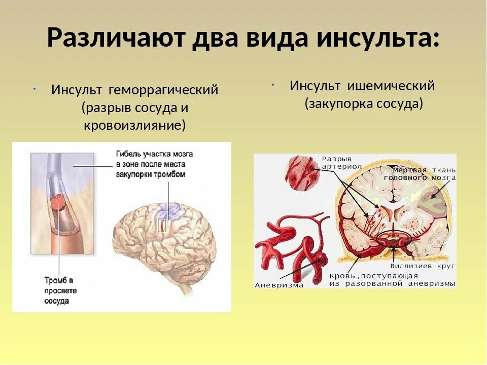 Доклад на тему инсульт. Презентация на тему геморрагический инсульт. Симптомы инсульта презентация.