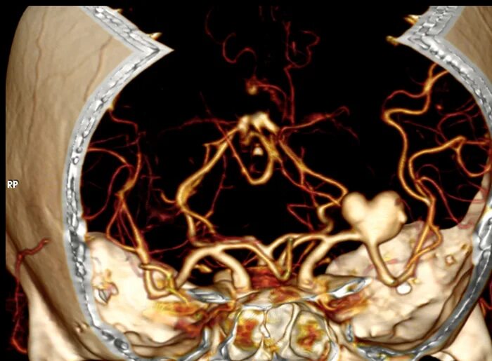 Магнитно-резонансная ангиография сосудов головного мозга. Мрт головного мозга с ангиографией интракраниальных сосудов. Кт ангиография интракраниальных артерий. Кт (компьютерная томография) сосудов головного мозга.