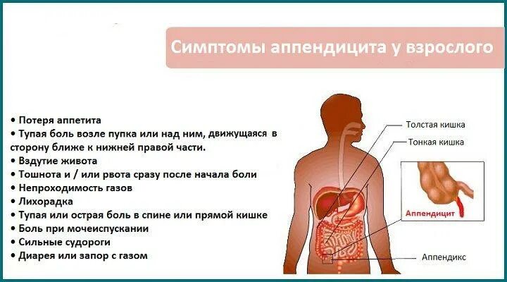 Аппендицит бывает у женщин. Начальные симптомы аппендицита. с какой стороны болит при аппендиците. аппендицит симптомы у взрослых. симптомы аппендицита у женщин.