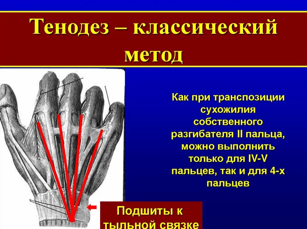 Транспозиция сухожилий. Транспозиция сухожилия разгибателя 2 пальца кисти. Тенодез сухожилия бицепса.