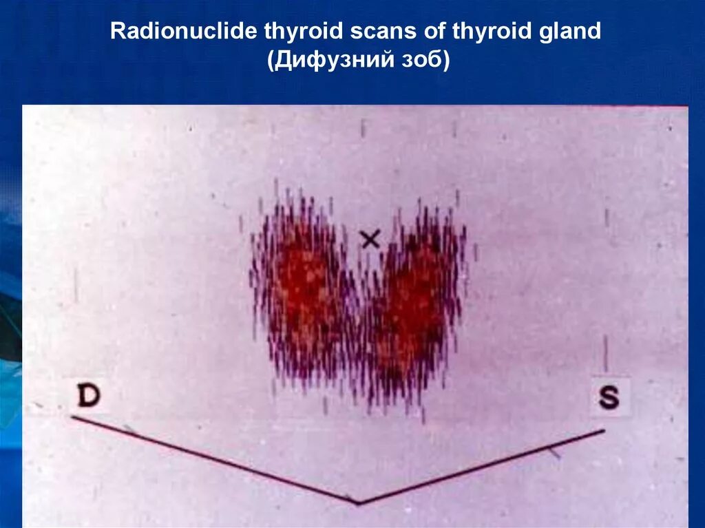 Диффузные л. Зоб щитовидной железы спорадический. Зоб щитовидной железы на сканограмме.