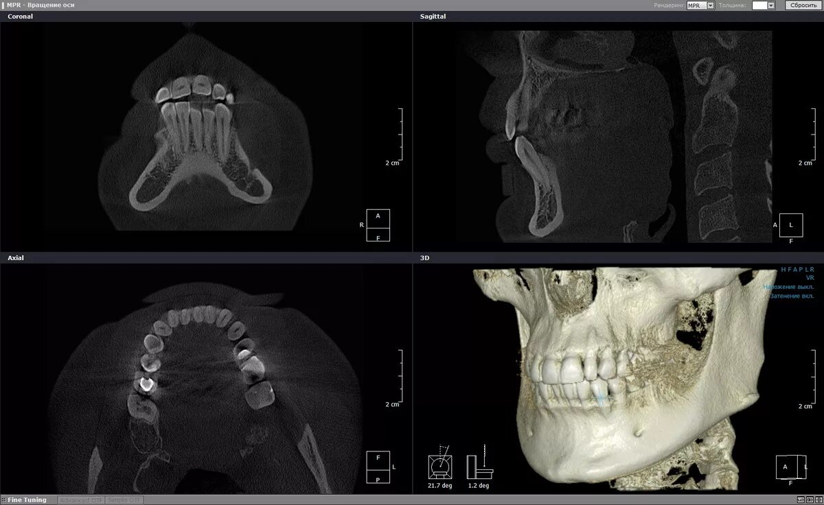 Кт 3d верхней и нижней челюсти. Компьютерная томография 2 челюсти. Кт верхней челюсти снимки. КЛКТ челюсти верхней и нижней челюсти.