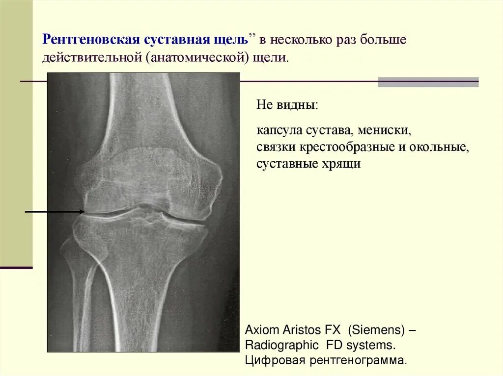 Щель является. Норма суставной щели рентген. анатомический субстрат рентгеновской суставной щели это. суставная щель коленного сустава рентген. ширина рентгеновской суставной щели тазобедренного сустава.