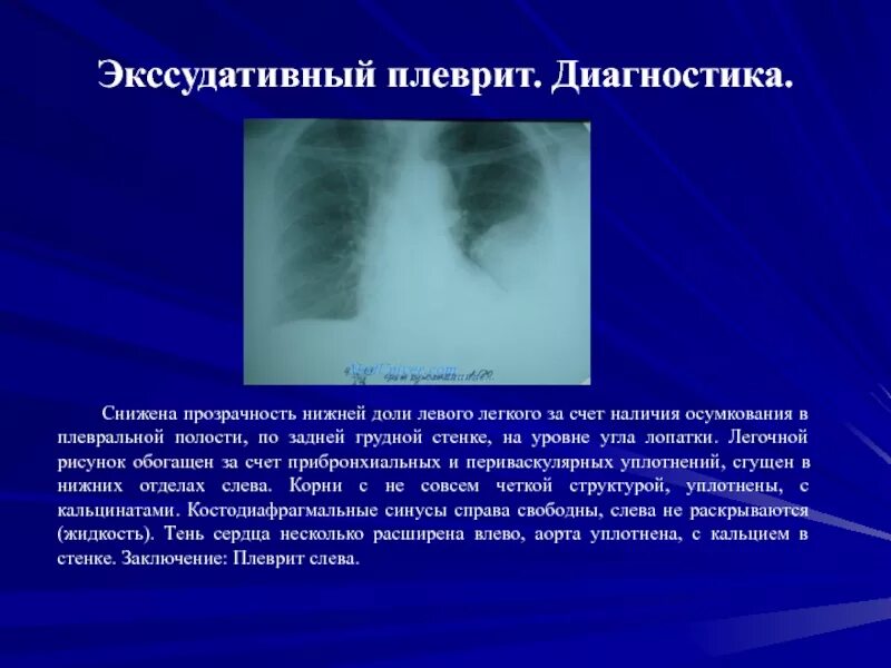 Томограмма легкого в прямой проекции. Снижение прозрачности легочной ткани. Снижение показателей. Снижение прозрачности легочной ткани на рентгене. Снижена прозрачность.