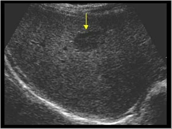Узи картина кавернозной гемангиомы печени. Как выглядит гемангиома на узи. Гистогенез гемангиомы печени. Как выглядит гемангиома на узи. Узи картина кавернозной гемангиомы печени.