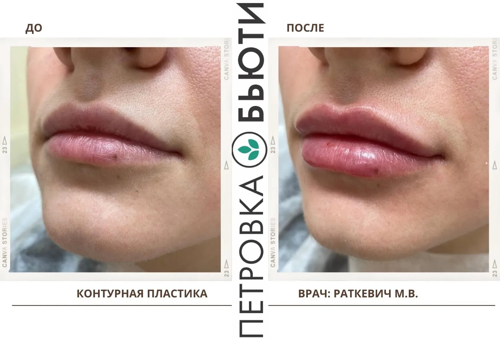 0 5 мл до после