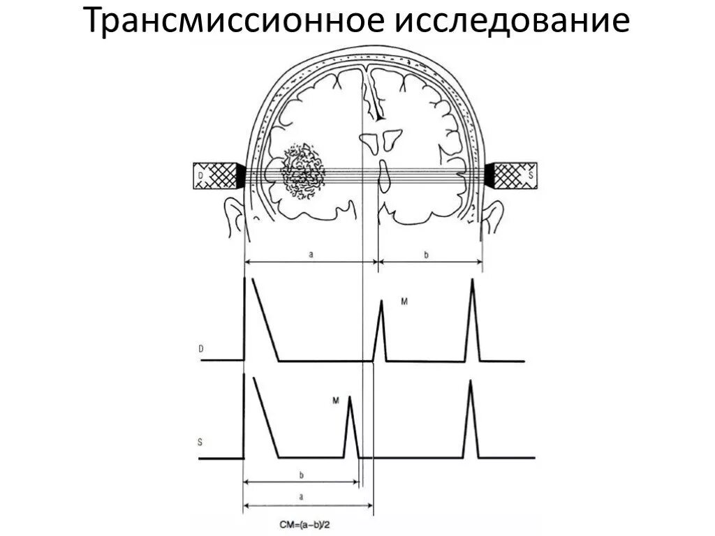 Эхо гостомеля. Эхоэнцефалоскопия. Эхоэнцефалография аппарат. Принцип работы эхоэнцефалоскопа. Эхоэнцефалоскопия ppt.