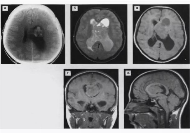 Киста головного мозга последствия. Неоперабельная киста в головном мозге. Опухоль головного мозга киста. Киста головного мозга симптомы. Опухоль ствола головного мозга.