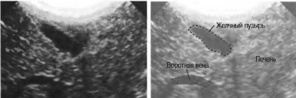 Желчный пузырь у новорожденного