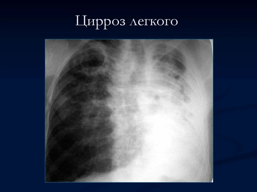 Фиброз в доле легкого. Цирротический туберкулез рентген. Цирротический туберкулёз лёгких. Цирротический туберкулез рентгенограмма. Цирротический туберкулез легких рентген.