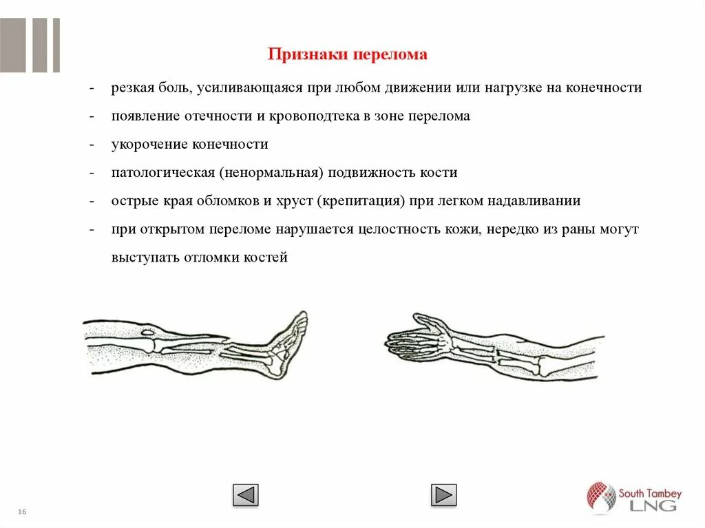 Сколько болит перелом ноги. Основные симптомы перелома костей конечностей. Признаками перелома конечности являются. Признаки закрытого перелома костей конечностей первая помощь. Перелом симптомы и признаки.