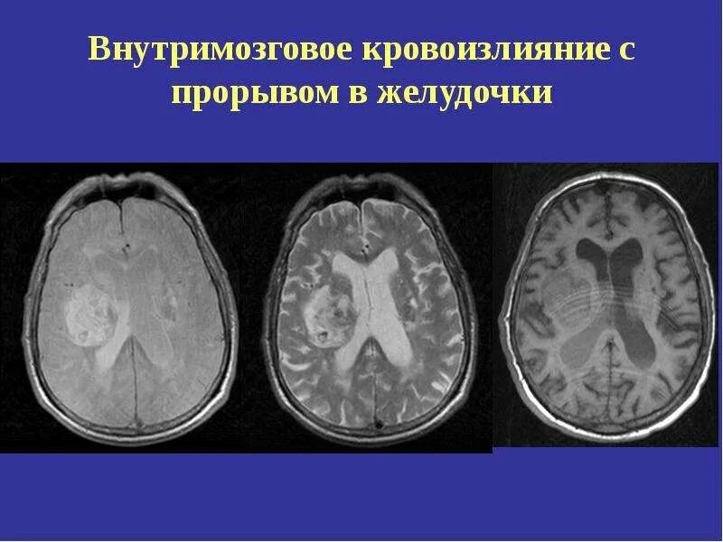 Таламическая гематома кт. Внутримозговая гематома кт. Внутримозговое кровоизлияние с прорывом в желудочки. Кровоизлияние в желудочки головного мозга кт.