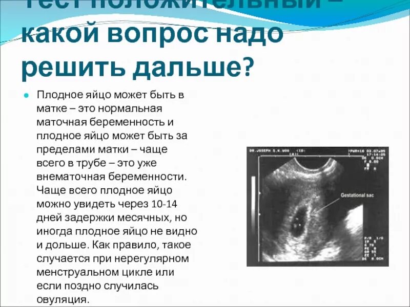 УЗИ прикрепление плодного яйца к матке. Низкое расположение плодного яйца. Низкое прикрепление плодного яйца. На узи видна труба