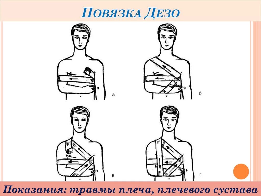 Плечевая повязка алгоритм. Технику наложения повязки Дезо.. Схема наложения повязки Дезо. Наложение повязки Дезо алгоритм. Повязка Дезо техника наложения.