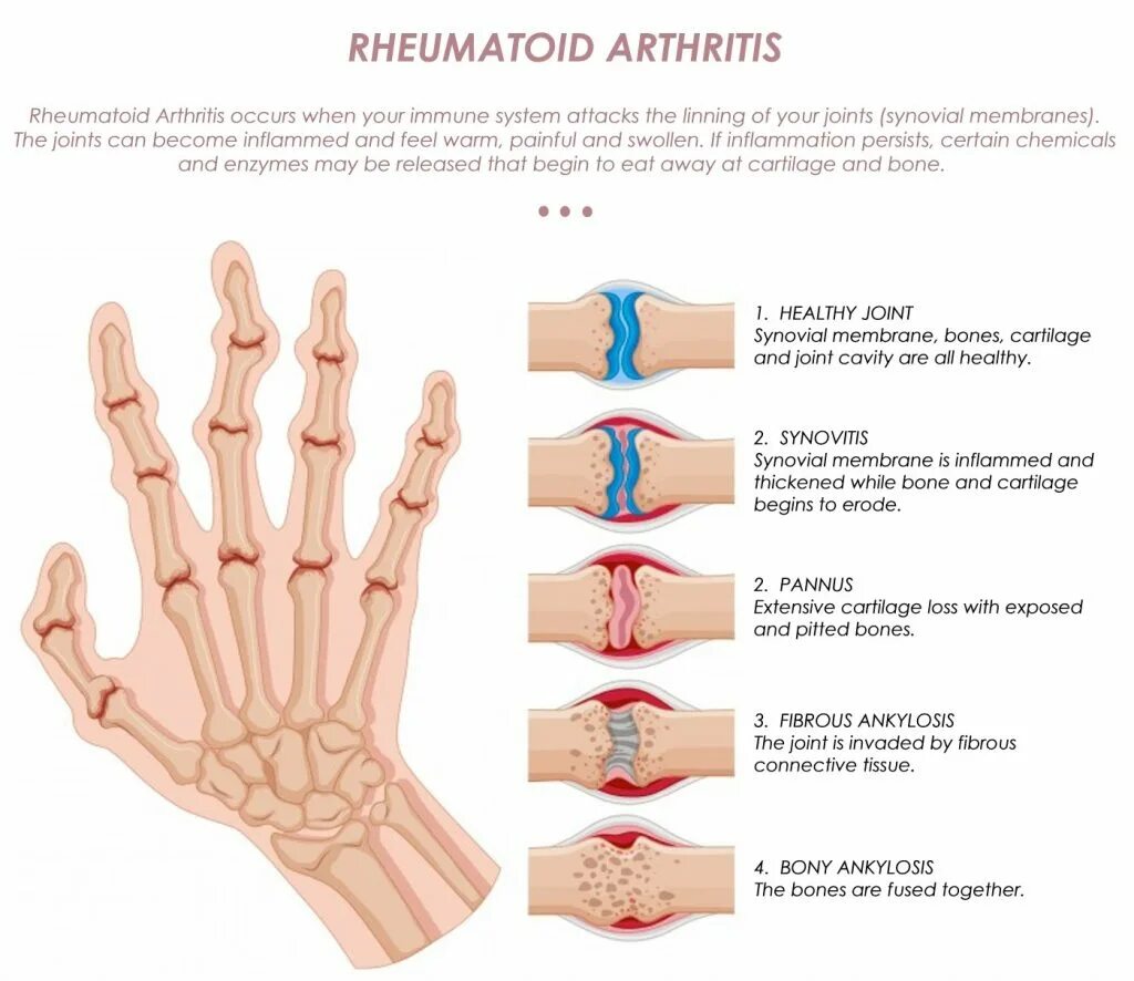 Стадии ревматоидного артрита паннус. Паннус при ревматоидном артрите. Ревматоидный артрит ногти. Ревматоидный артрит мышцы