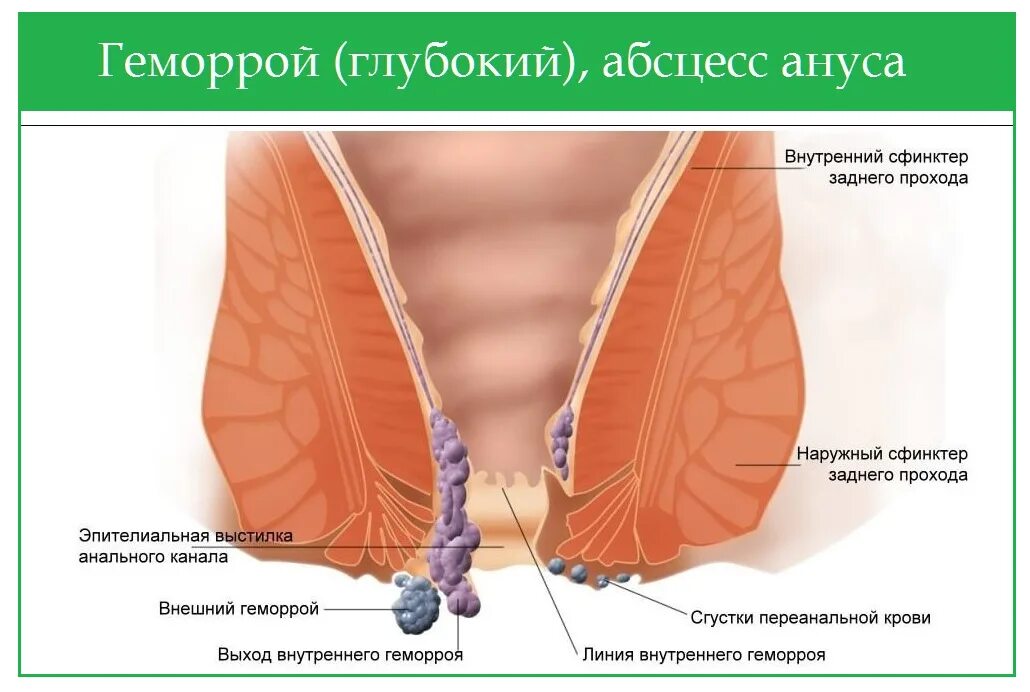 Сфинктерит прямой кишки симптомы. Наружный сфинктер прямой кишки. наружный и внутренний сфинктер прямой кишки. геморрой тромбоз наружного узла.