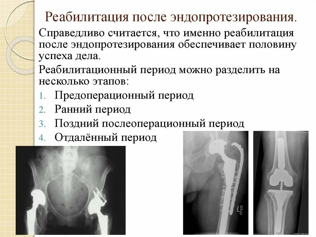 Этапы реабилитации после эндопротезирования тазобедренного сустава. Реабилитация после эндопротезирования тазобедренного сустава. Стационарная реабилитация после эндопротезирования. Предоперационный период эндопротезирования. Суть операции эндопротезирования