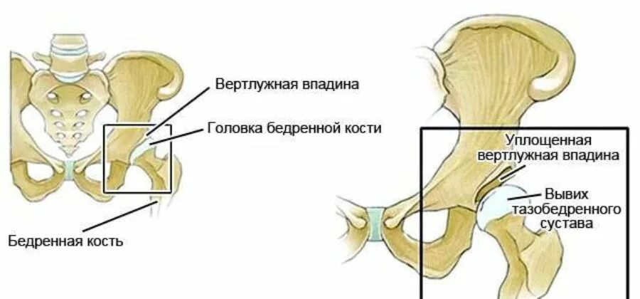 Незрелость тазобедренных суставов в 1 месяц. Классификация дисплазии вертлужной впадины. дисплазия вертлужных впадин. смещение тазобедренных суставов у новорожденных. лимбус вертлужной впадины.