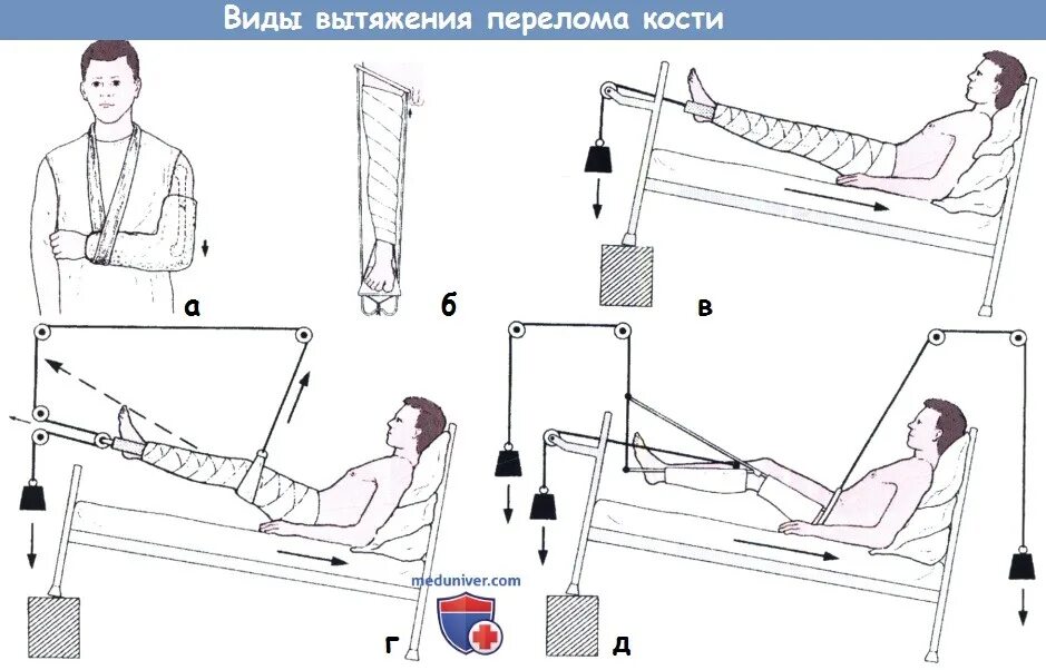 Вытяжение при переломе. Скелетное вытяжение при переломе бедренной кости. скелетное вытяжение тазобедренного сустава.