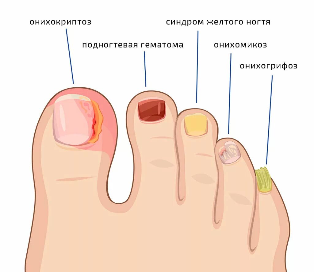 Проблема с ногтями к какому врачу обратиться. Онихокриптоз вросший ноготь. Дистально латеральный онихомикоз.